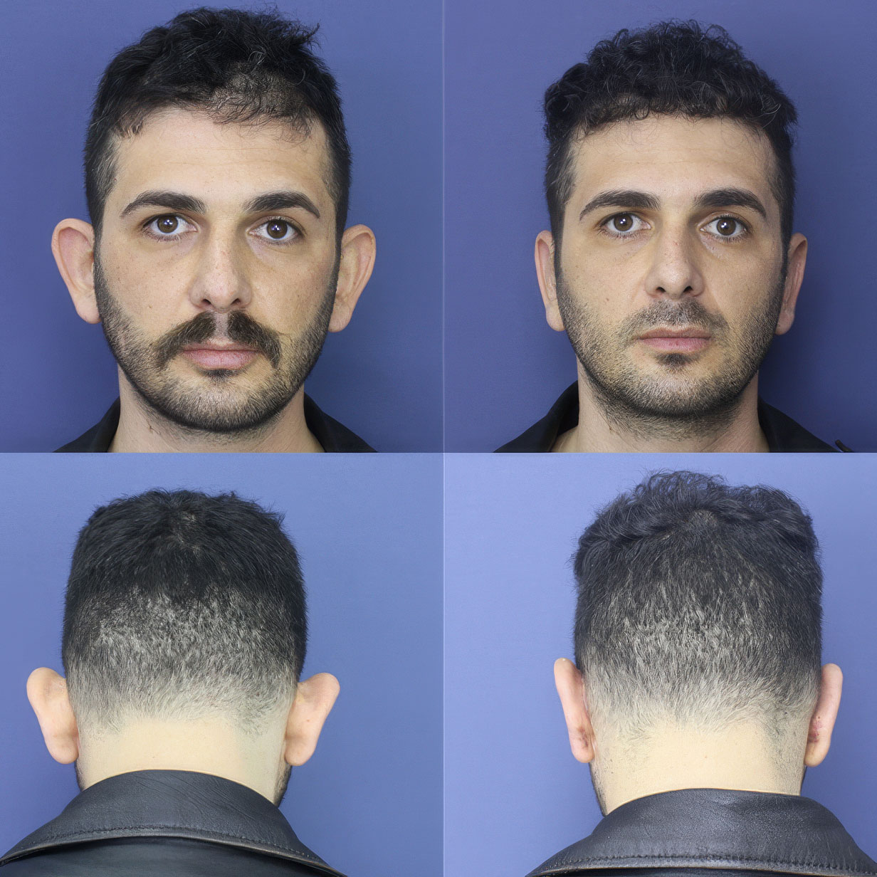 Estetik Kulak Ameliyatlarında Doğal Sonuçlar