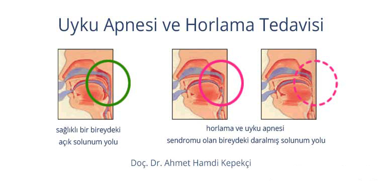 Horlama Tedavisi