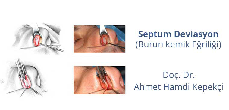 Burun Kemiği Eğriliği Nedir?