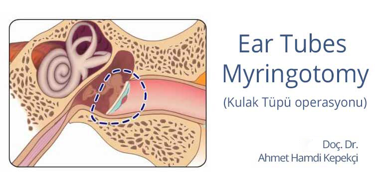 Kulak Tüpü Nedir?