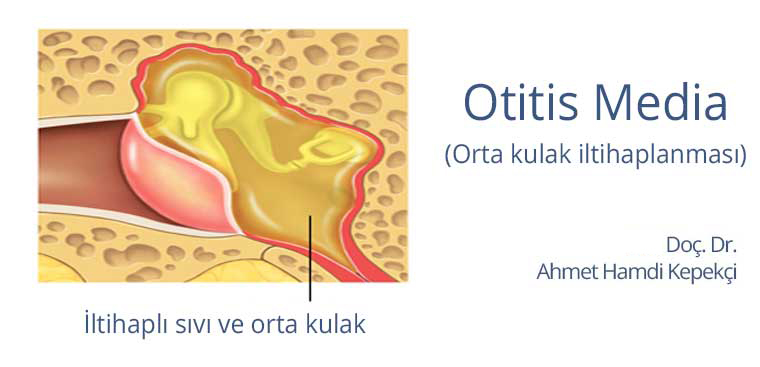 Orta Kulak İltihabı Nedir?