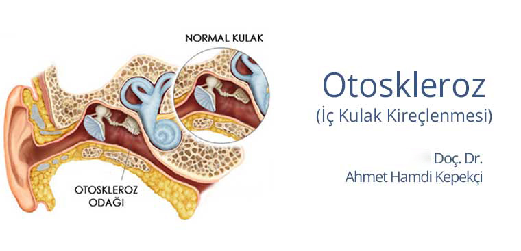 Otoskleroz Nedir?